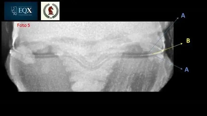 Qual é o verdadeiro espaço articular numa radiografia?